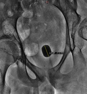 Minimally Invasive Management of Bladder Stones in Children
